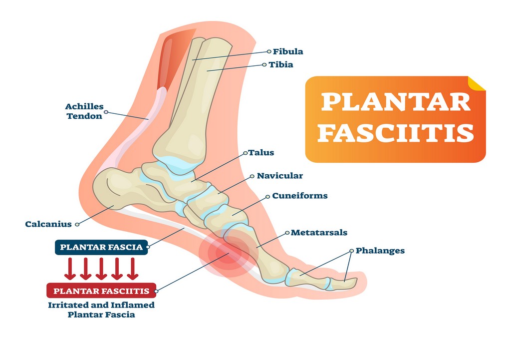 what is plantar fasciitis